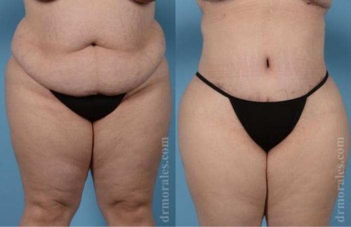 Before & After Tummy Tuck Case 522 View 1 View in Houston, TX