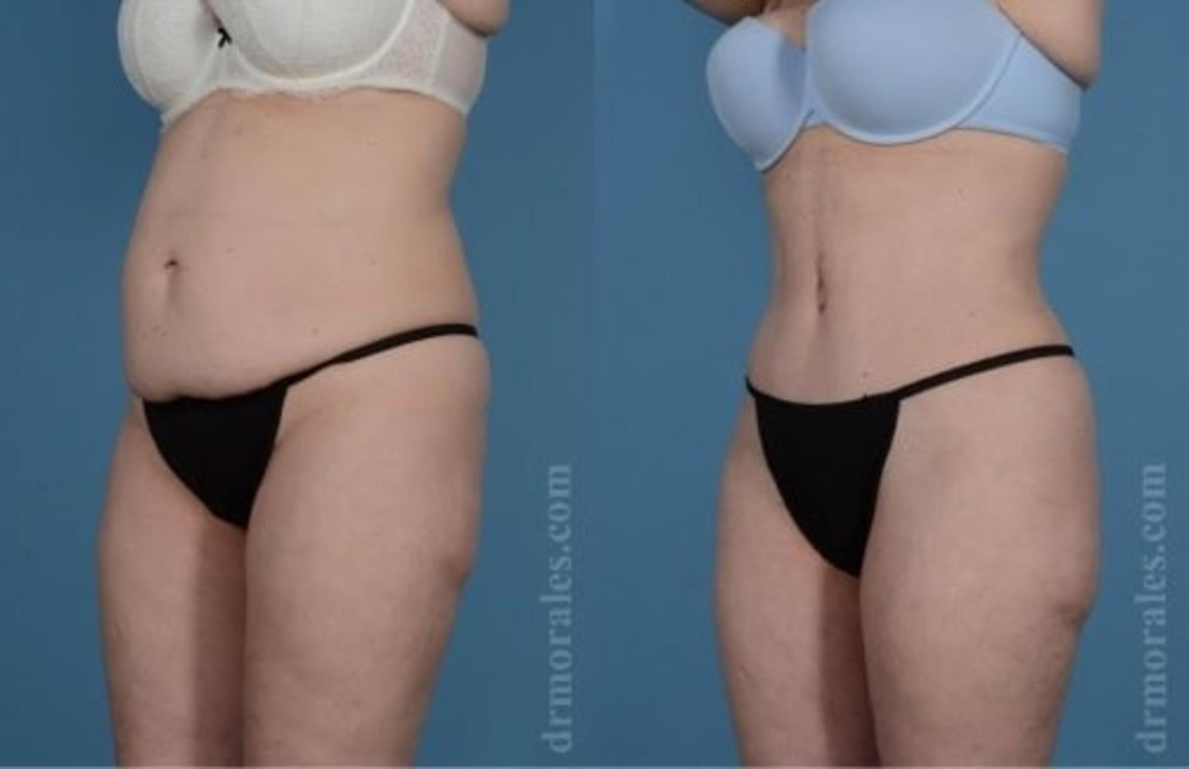Before & After Tummy Tuck Case 523 View 1 View in Houston, TX