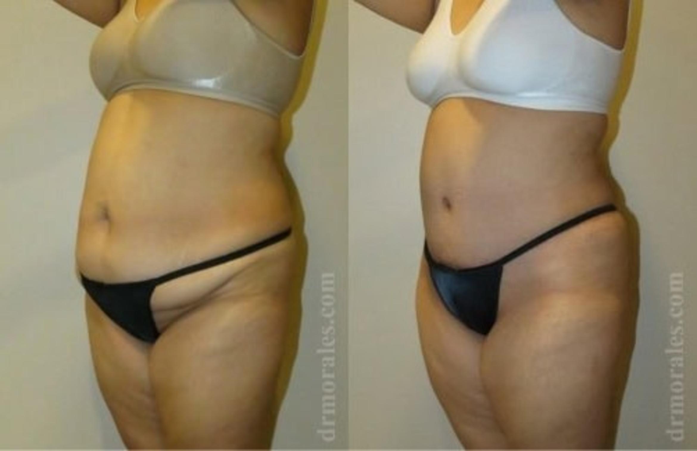 Before & After Tummy Tuck Case 524 View 1 View in Houston, TX