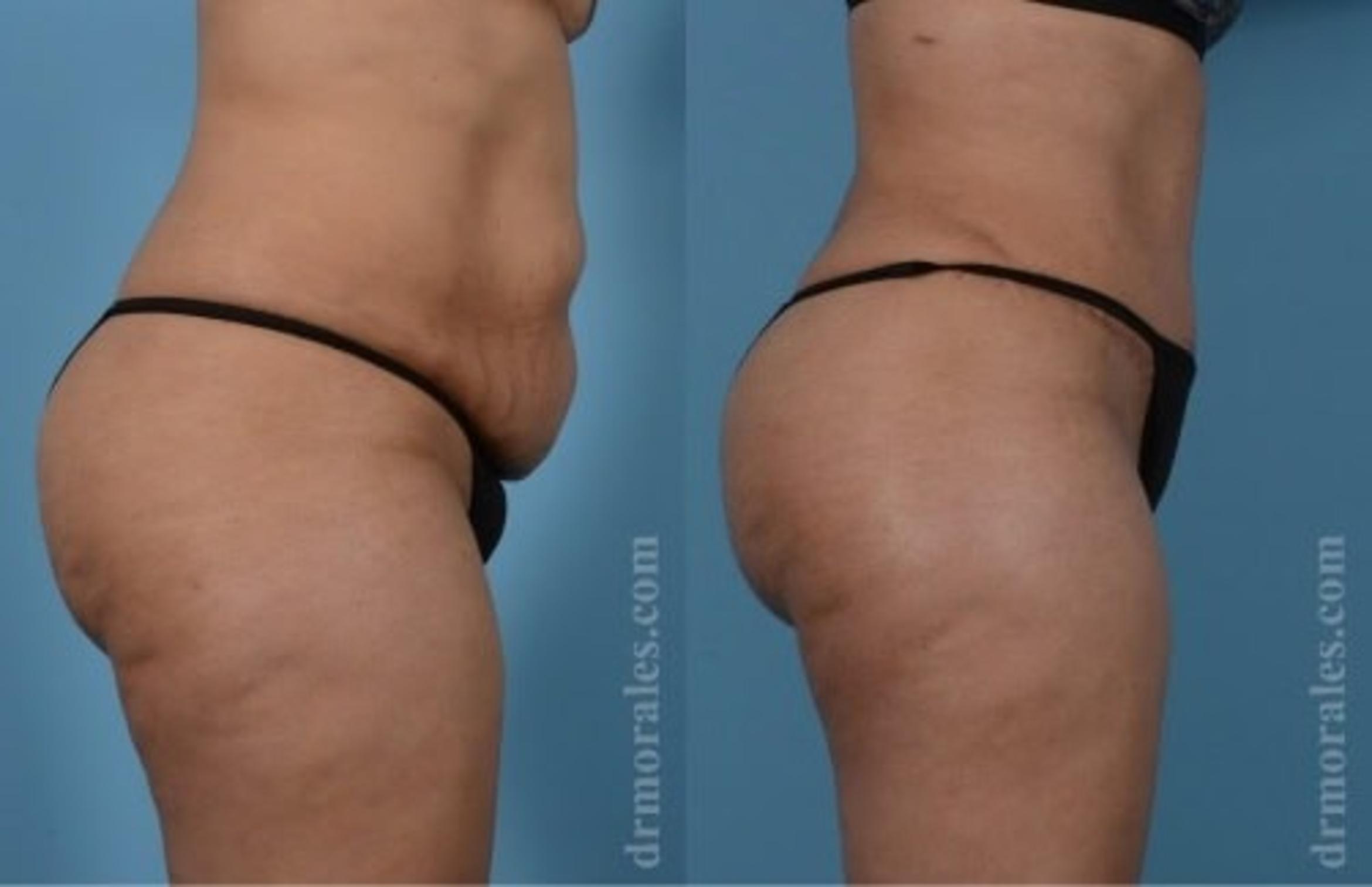 Before & After Tummy Tuck Case 525 View 1 View in Houston, TX