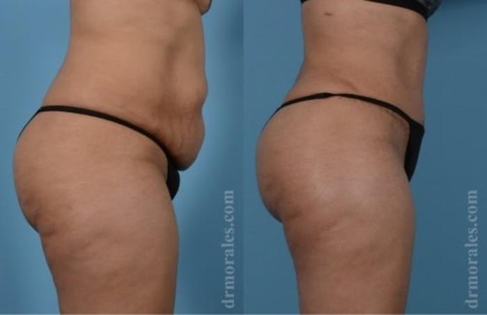 Before & After Tummy Tuck Case 525 View 1 View in Houston, TX