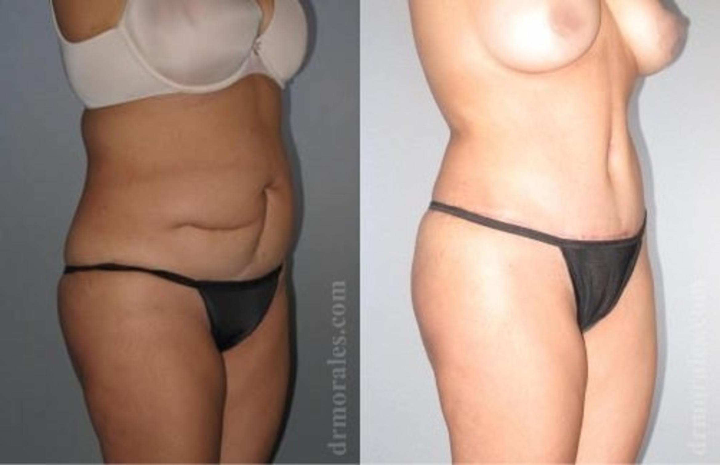 Before & After Tummy Tuck Case 526 View 1 View in Houston, TX