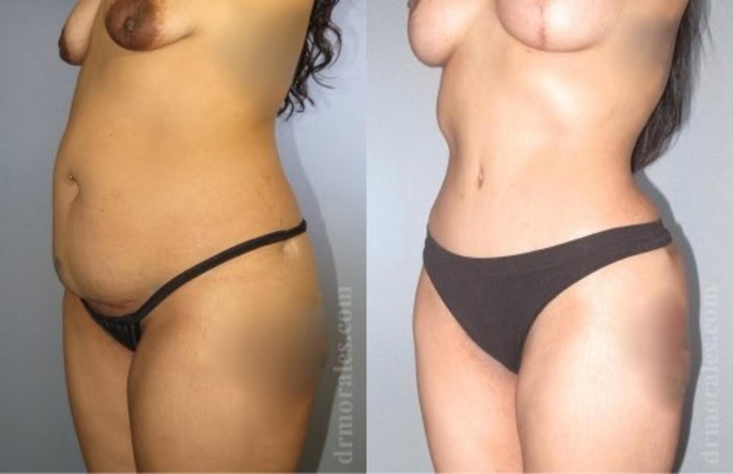 Before & After Tummy Tuck Case 527 View 1 View in Houston, TX