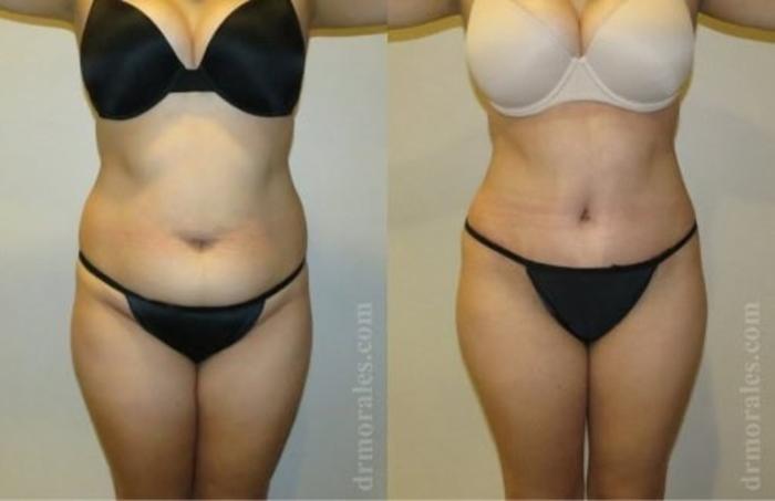 Before & After Tummy Tuck Case 528 View 1 View in Houston, TX