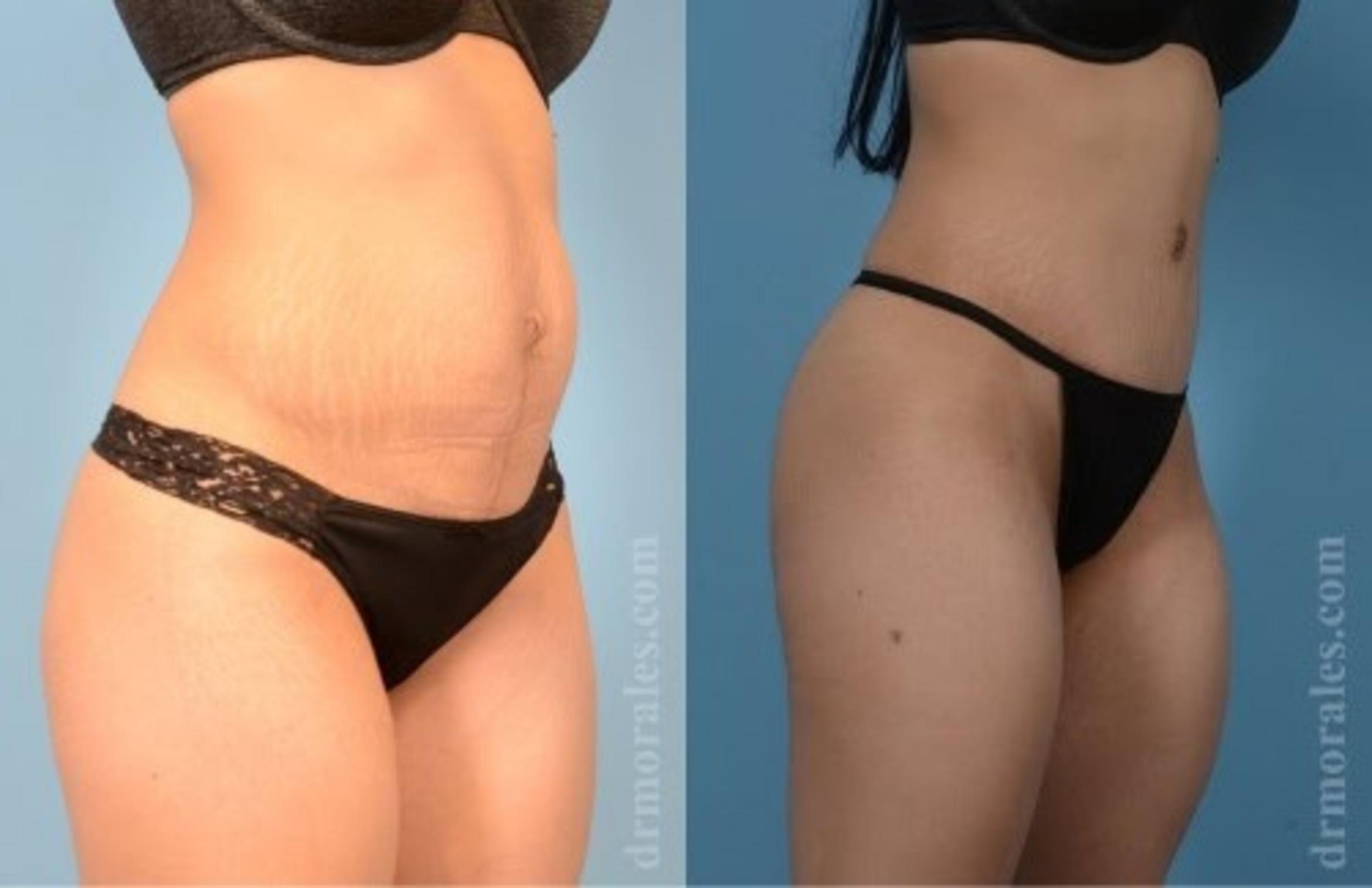 Before & After Tummy Tuck Case 529 View 1 View in Houston, TX