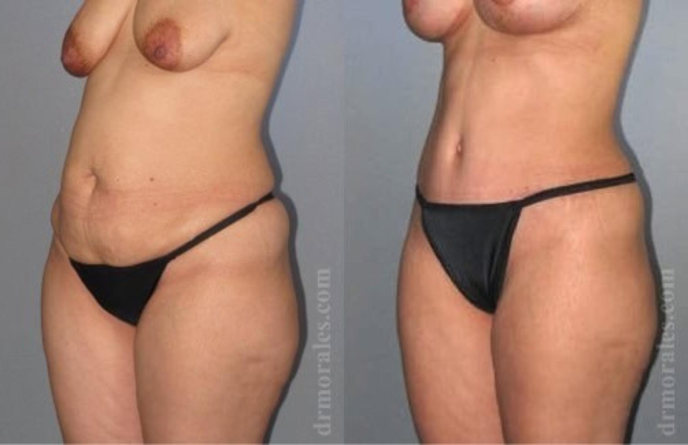 Before & After Tummy Tuck Case 530 View 1 View in Houston, TX