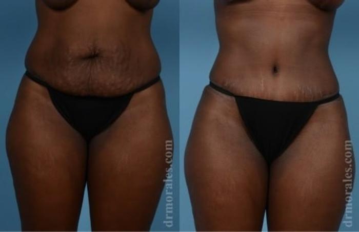 Before & After Tummy Tuck Case 531 View 1 View in Houston, TX