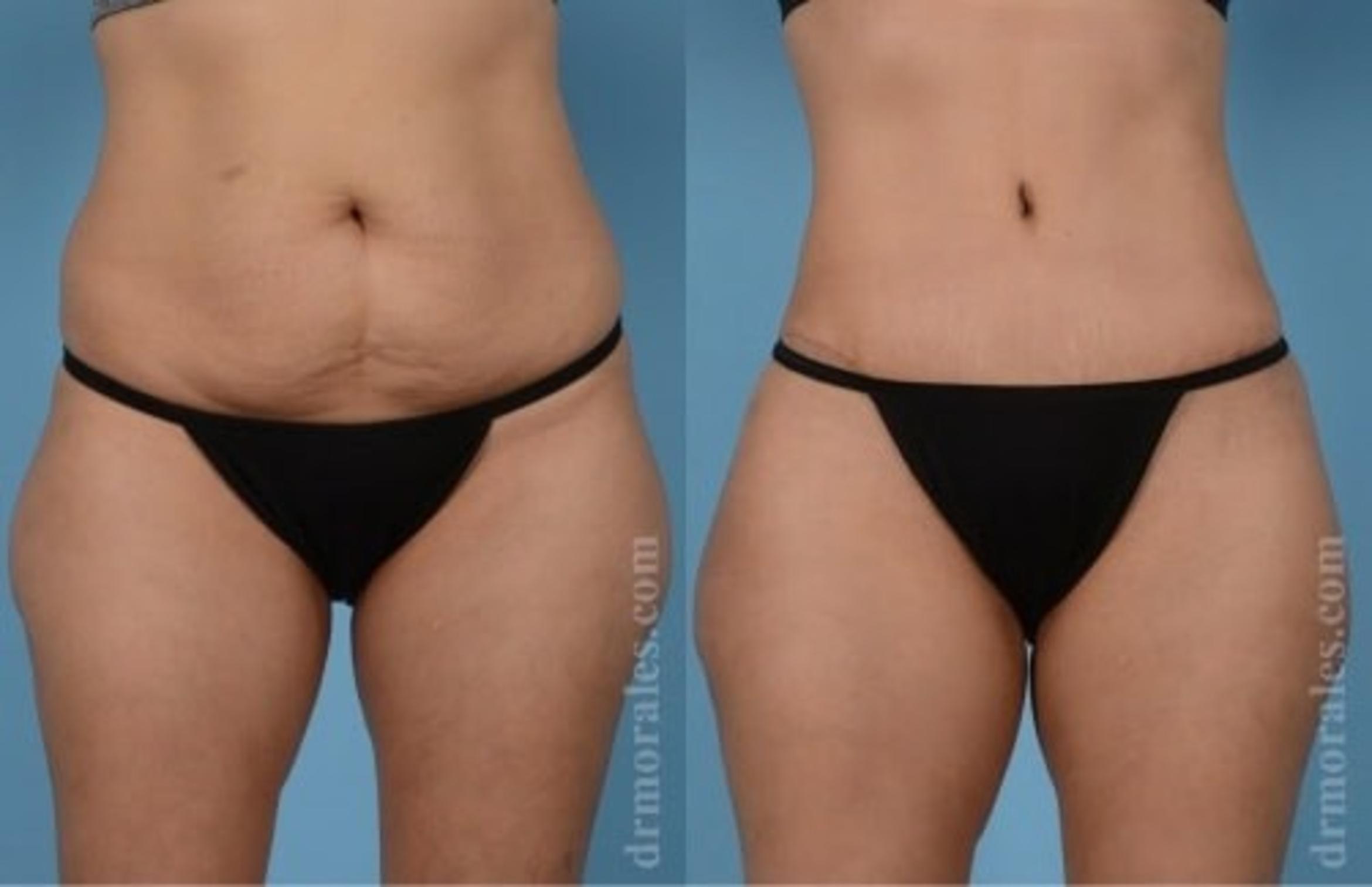 Before & After Tummy Tuck Case 532 View 1 View in Houston, TX
