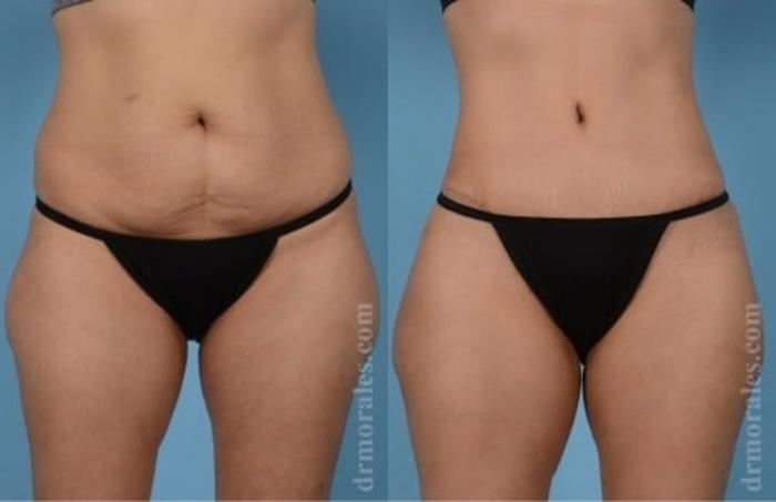 Before & After Tummy Tuck Case 532 View 1 View in Houston, TX