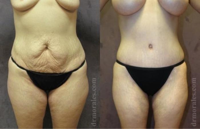 Before & After Tummy Tuck Case 533 View 1 View in Houston, TX