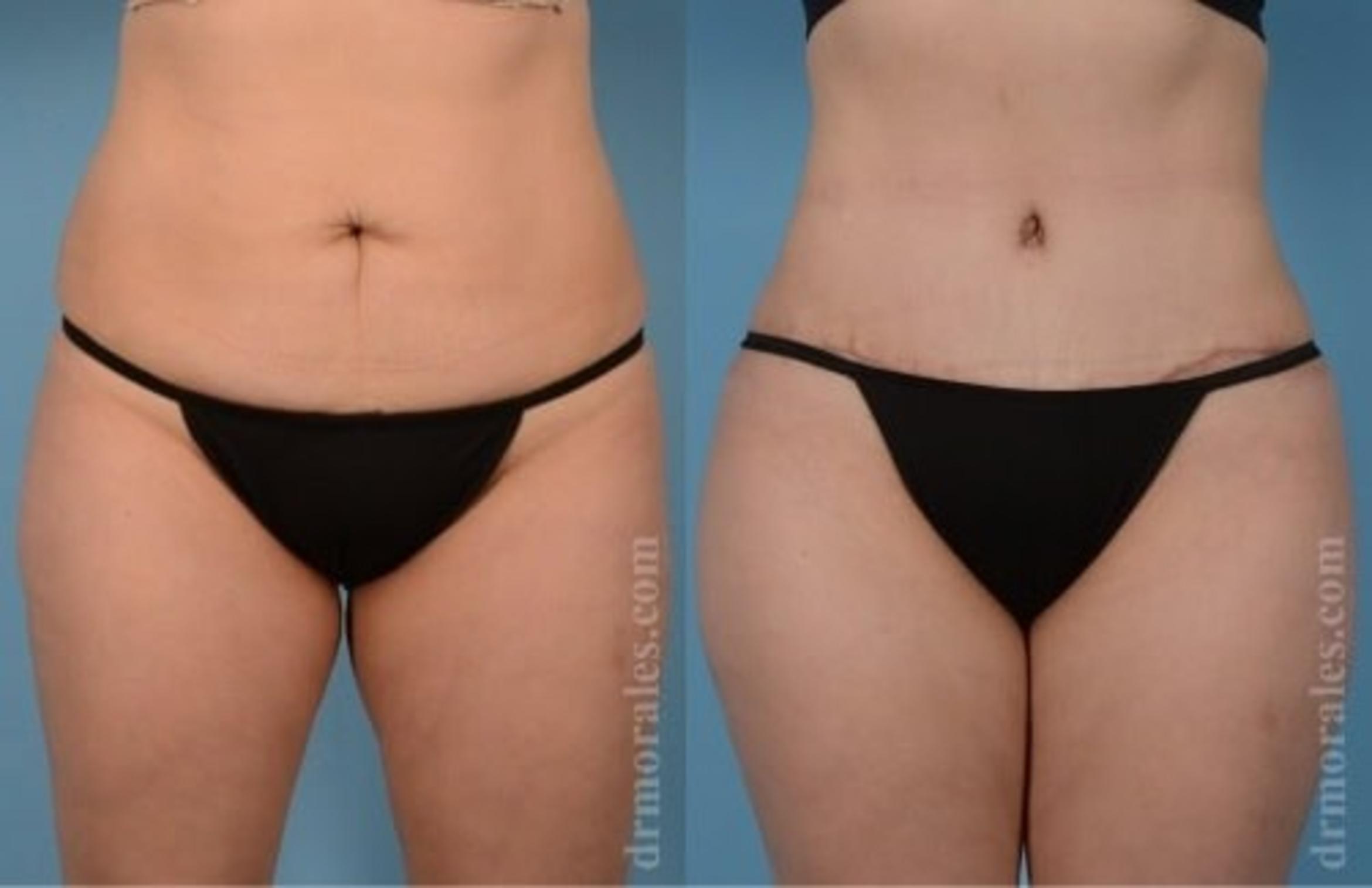 Before & After Tummy Tuck Case 534 View 1 View in Houston, TX