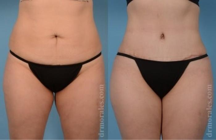 Before & After Tummy Tuck Case 534 View 1 View in Houston, TX