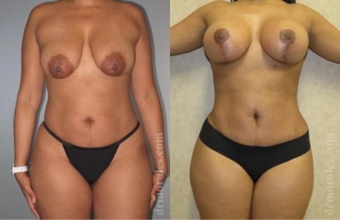 Before & After Tummy Tuck Case 536 View 1 View in Houston, TX