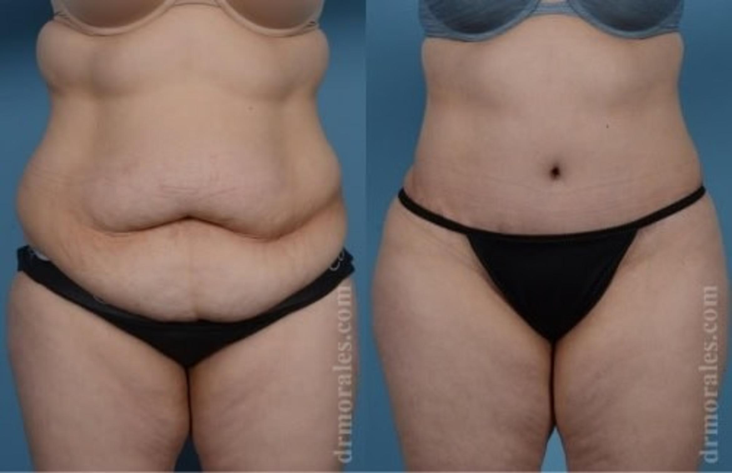Before & After Tummy Tuck Case 537 View 1 View in Houston, TX