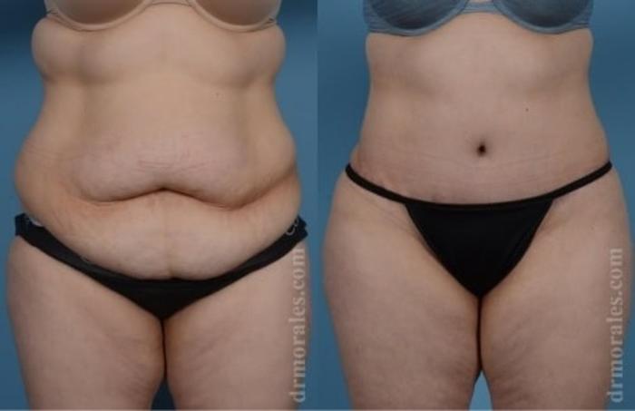 Before & After Tummy Tuck Case 537 View 1 View in Houston, TX