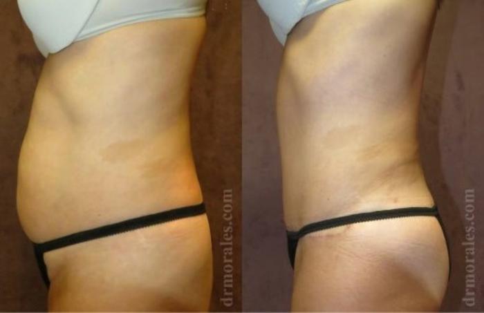 Before & After Tummy Tuck Case 538 View 1 View in Houston, TX
