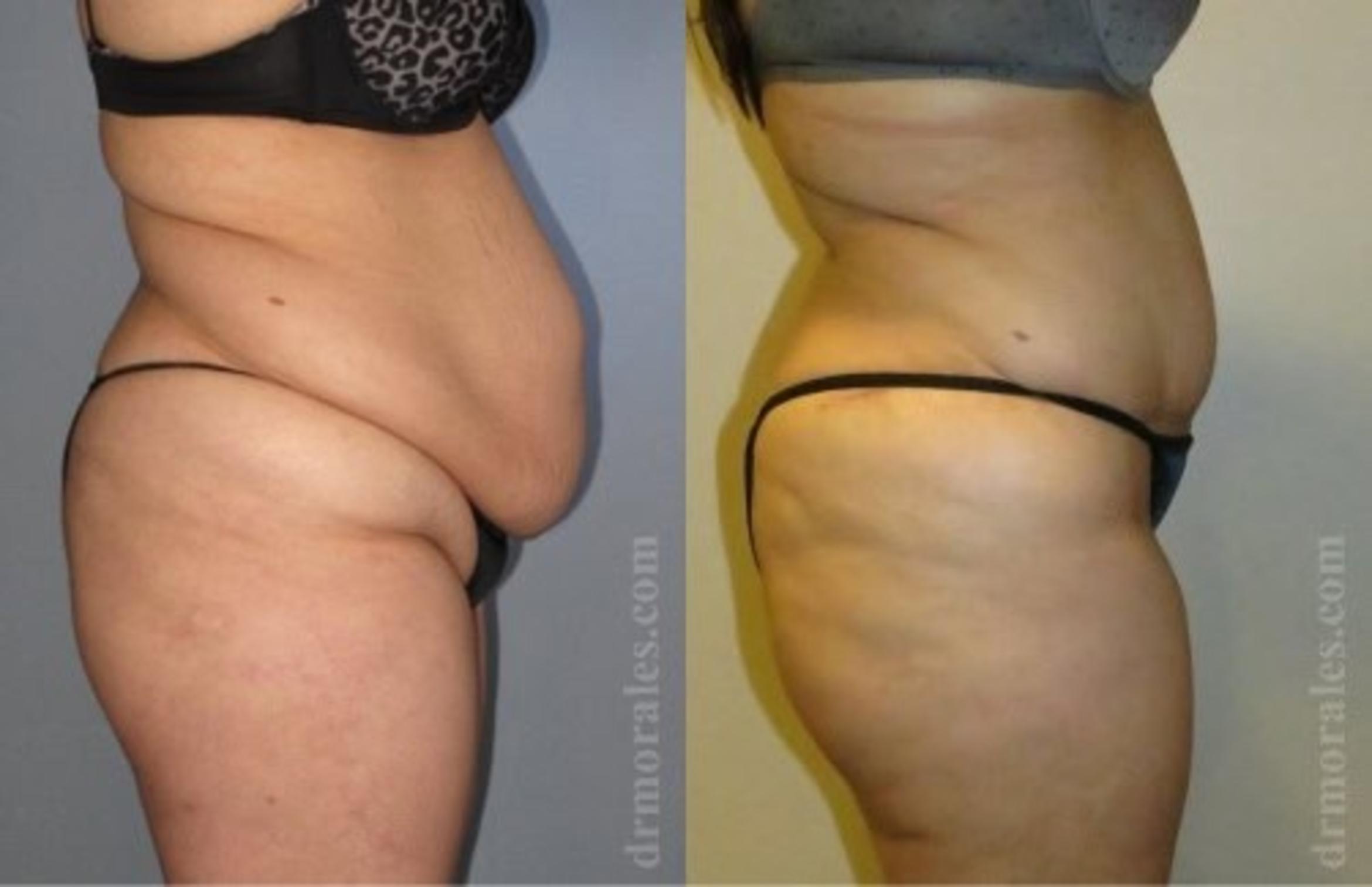 Before & After Tummy Tuck Case 540 View 1 View in Houston, TX
