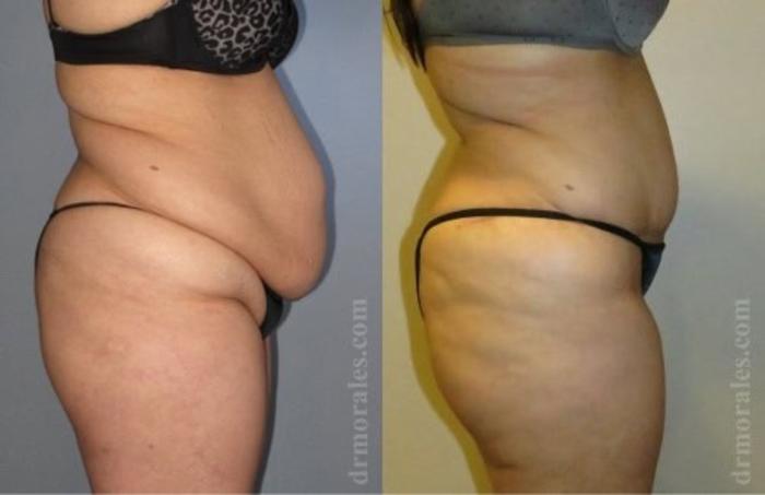 Before & After Tummy Tuck Case 540 View 1 View in Houston, TX
