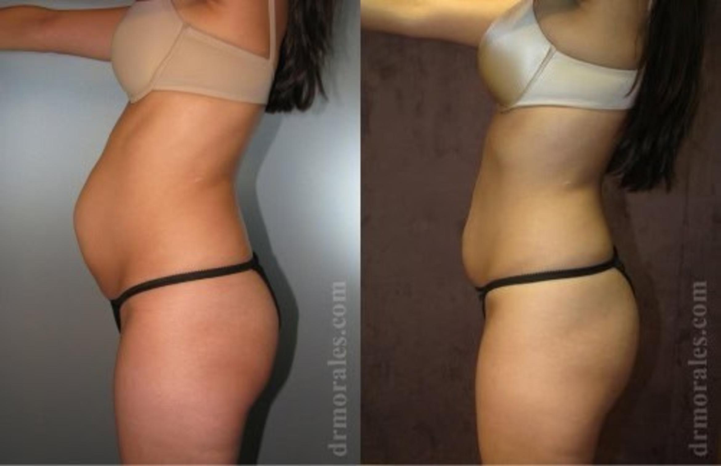 Before & After Tummy Tuck Case 541 View 1 View in Houston, TX