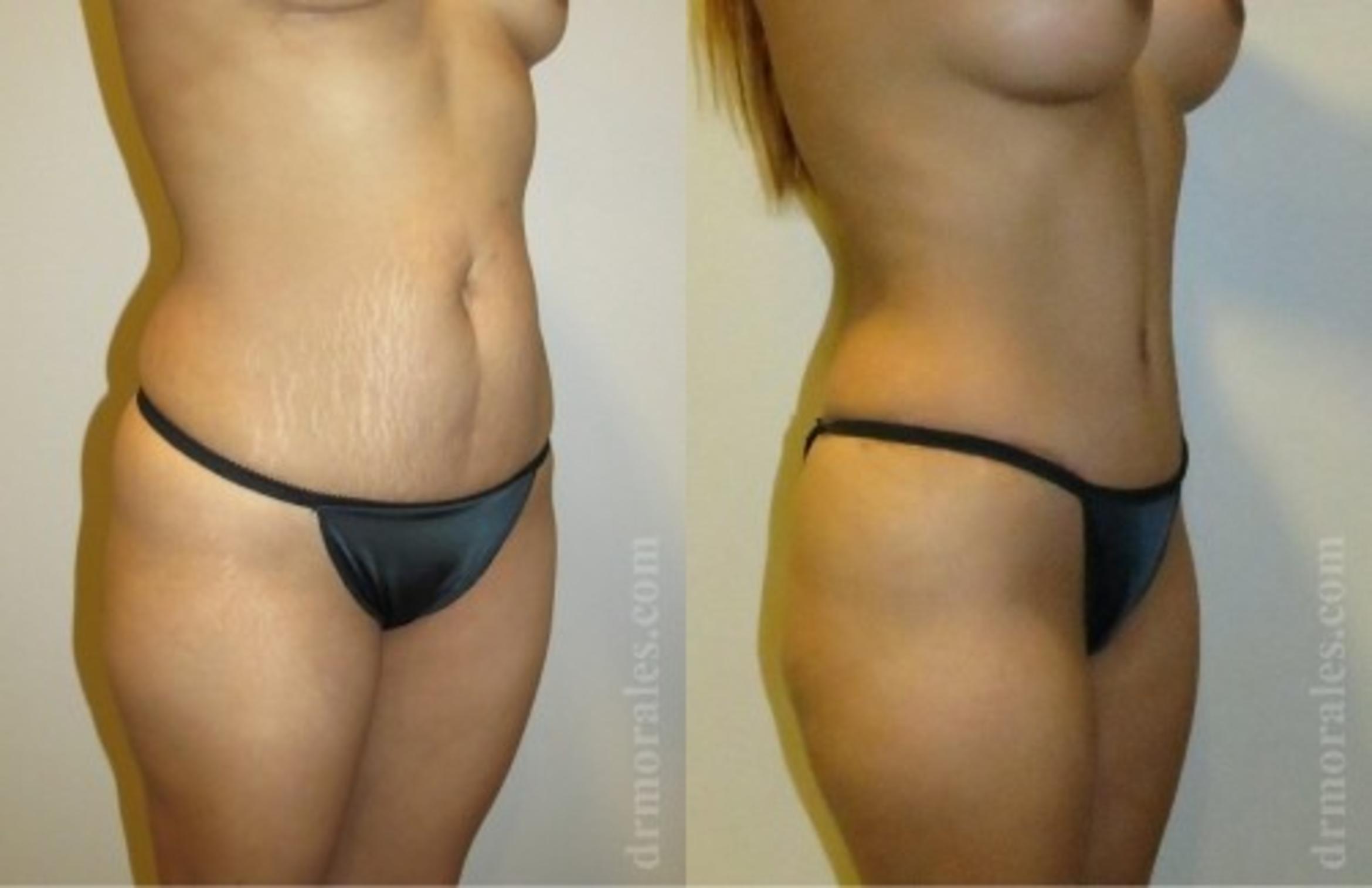 Before & After Tummy Tuck Case 543 View 1 View in Houston, TX