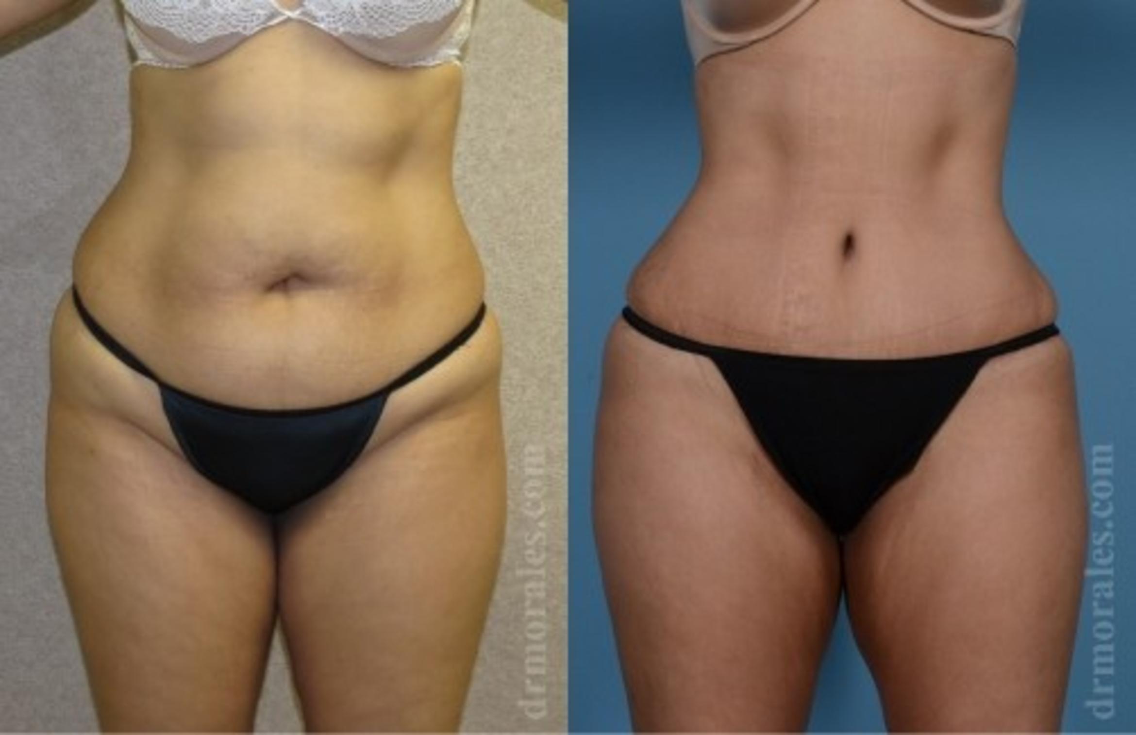 Before & After Tummy Tuck Case 544 View 1 View in Houston, TX