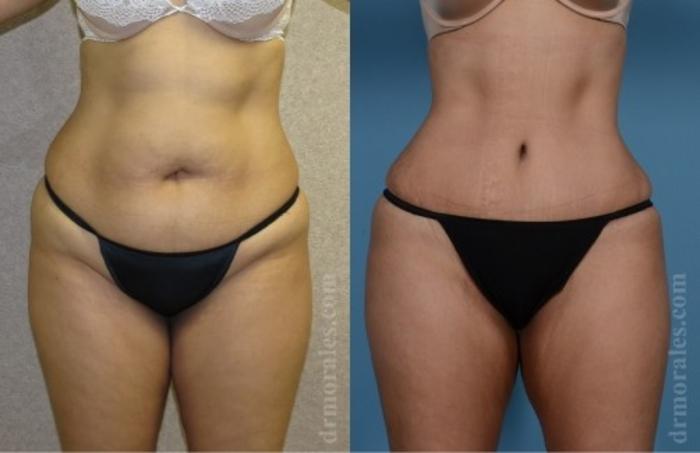 Before & After Tummy Tuck Case 544 View 1 View in Houston, TX