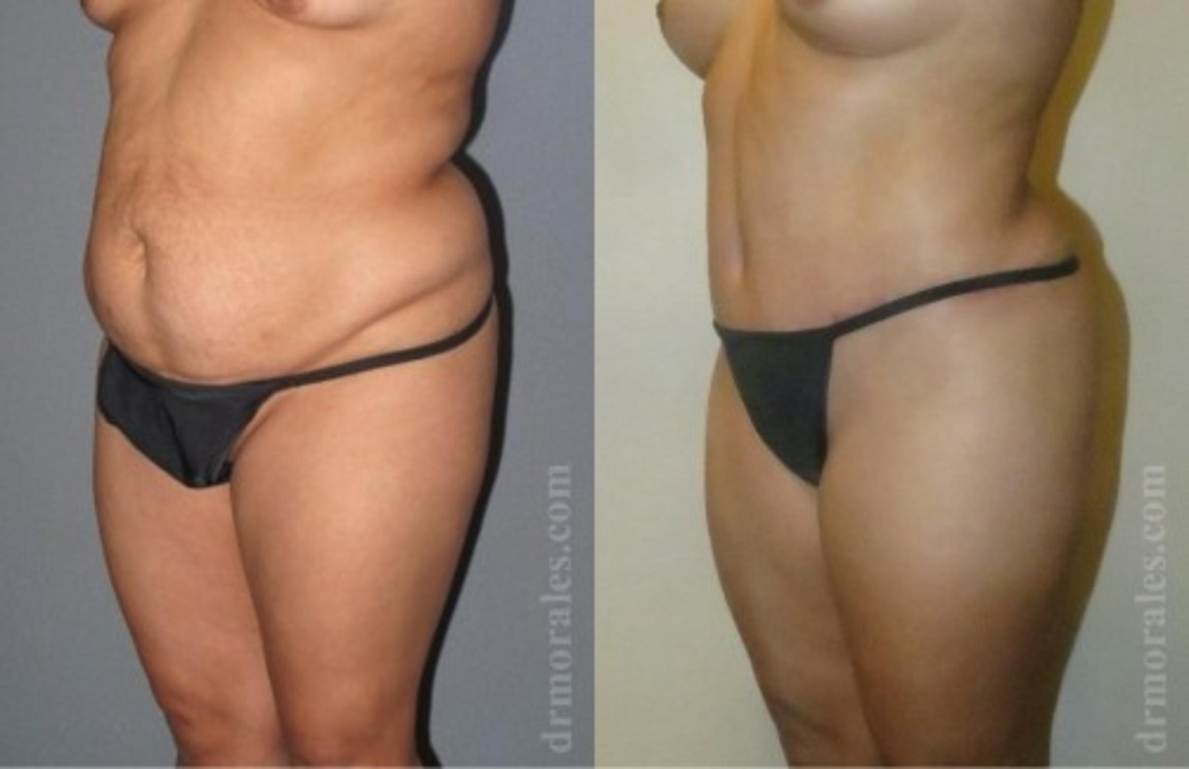 Before & After Tummy Tuck Case 546 View 1 View in Houston, TX