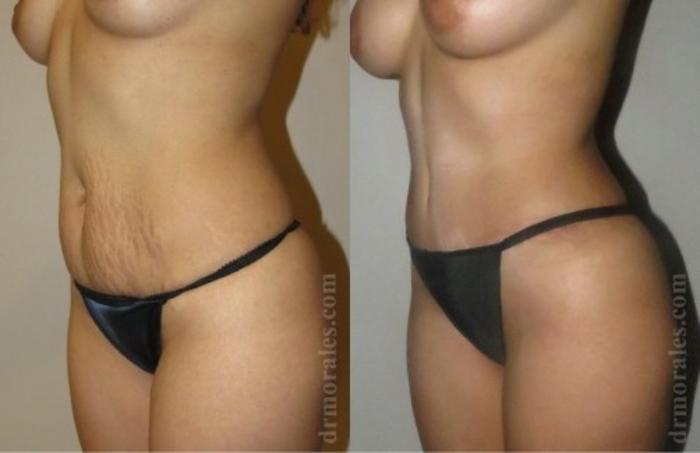 Before & After Tummy Tuck Case 549 View 1 View in Houston, TX
