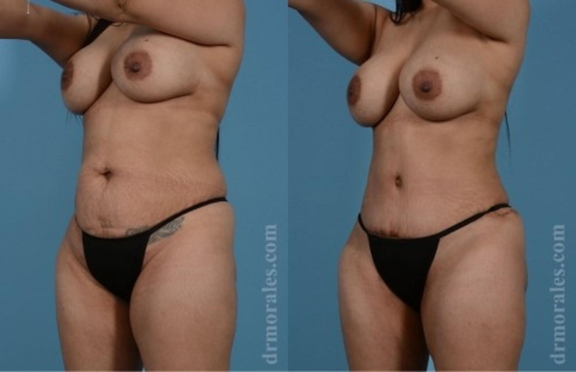 Before & After Tummy Tuck Case 550 View 1 View in Houston, TX