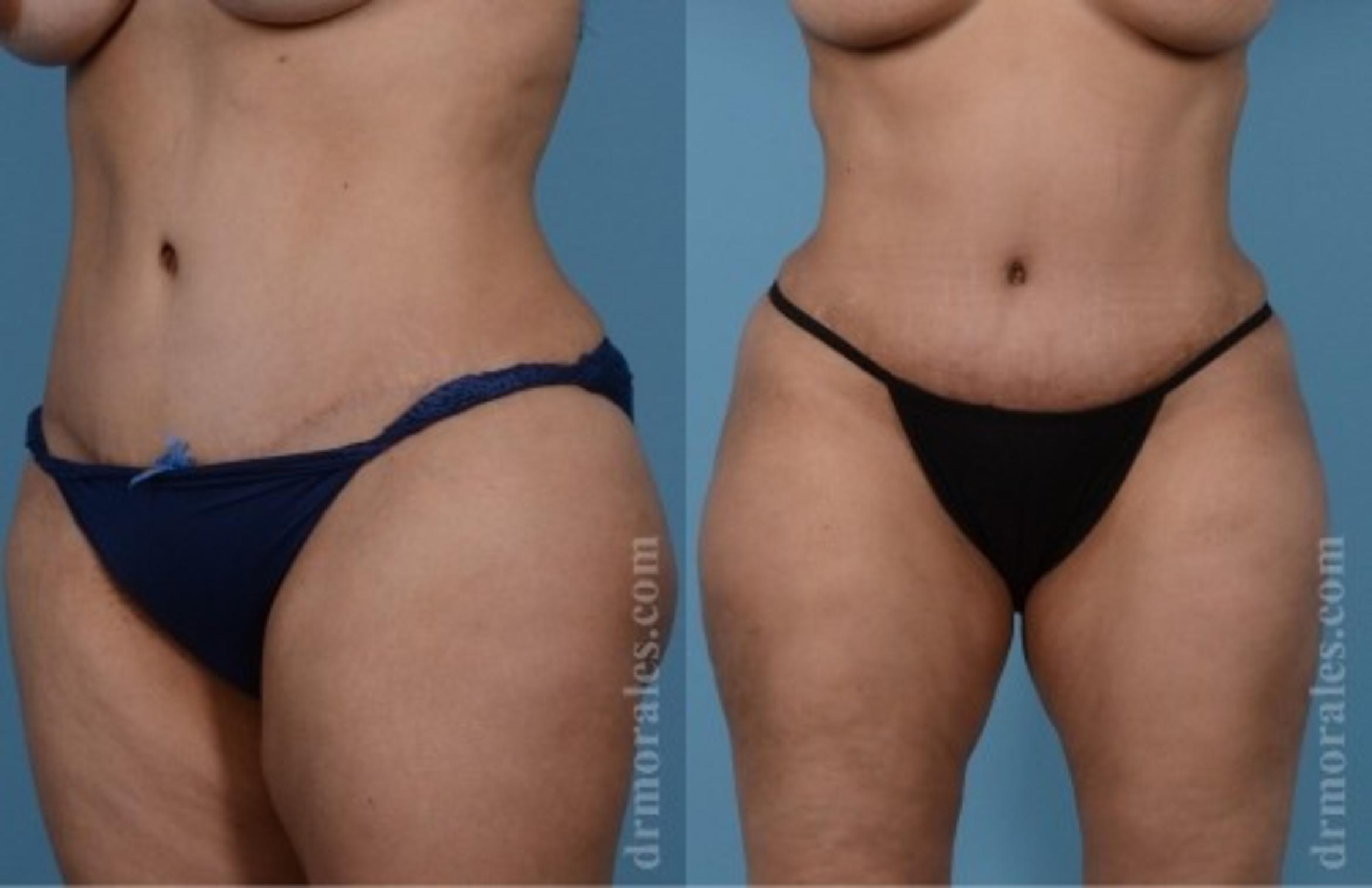 Before & After Tummy Tuck Case 551 View 1 View in Houston, TX