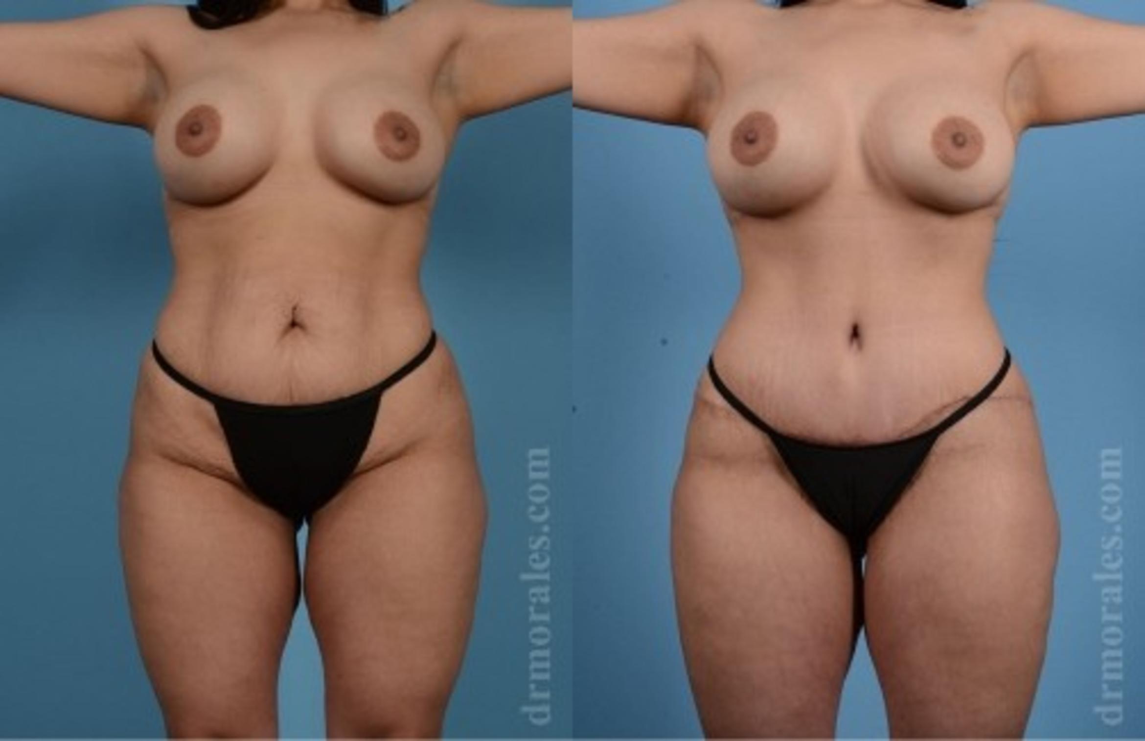 Before & After Tummy Tuck Case 552 View 1 View in Houston, TX