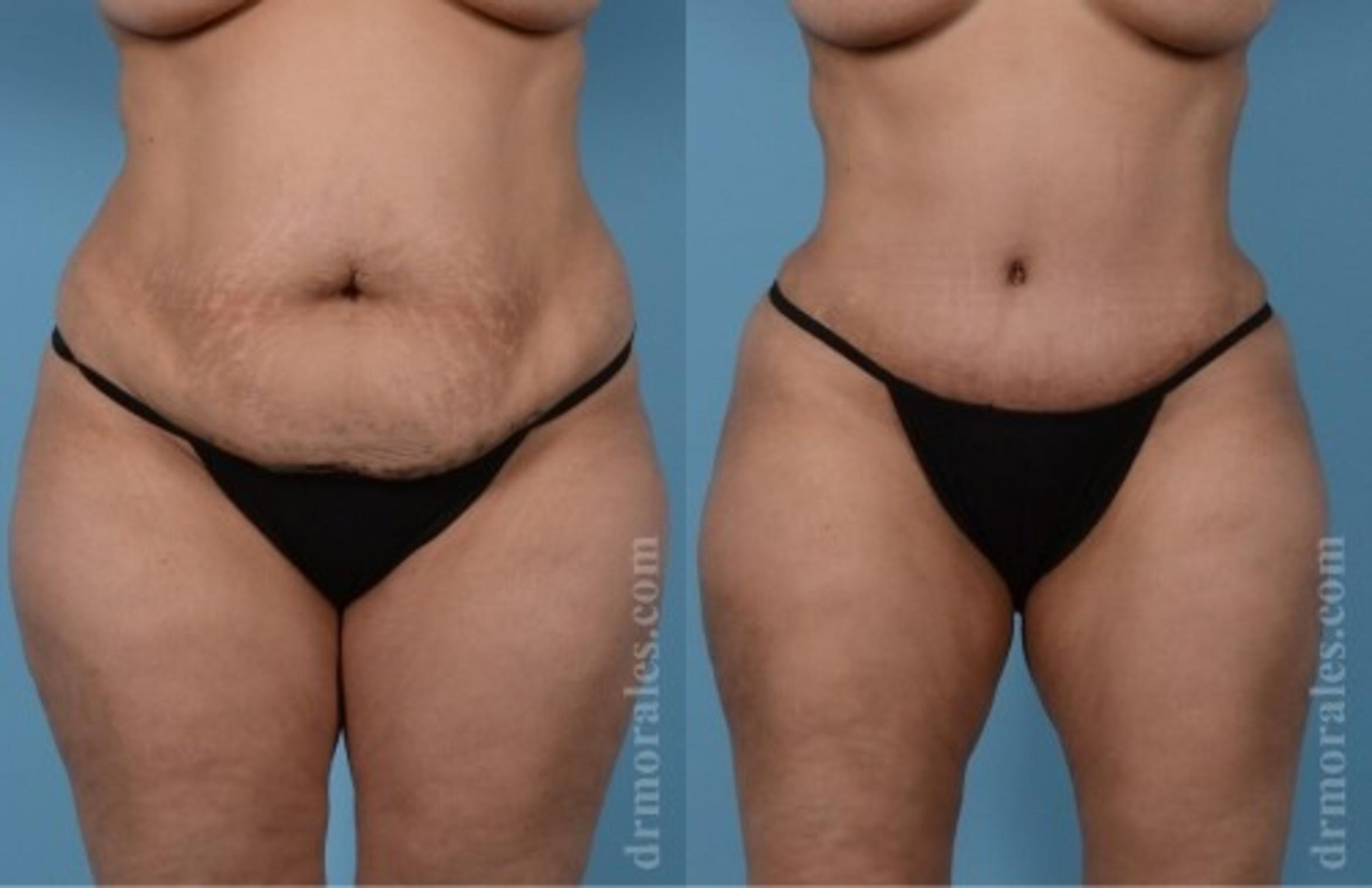 Before & After Tummy Tuck Case 553 View 1 View in Houston, TX