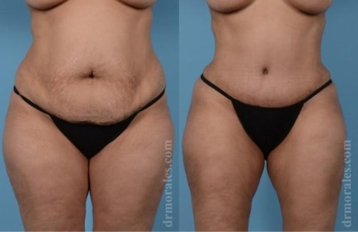 Before & After Tummy Tuck Case 553 View 1 View in Houston, TX