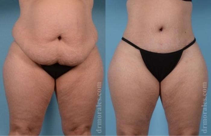 Before & After Tummy Tuck Case 556 View 1 View in Houston, TX