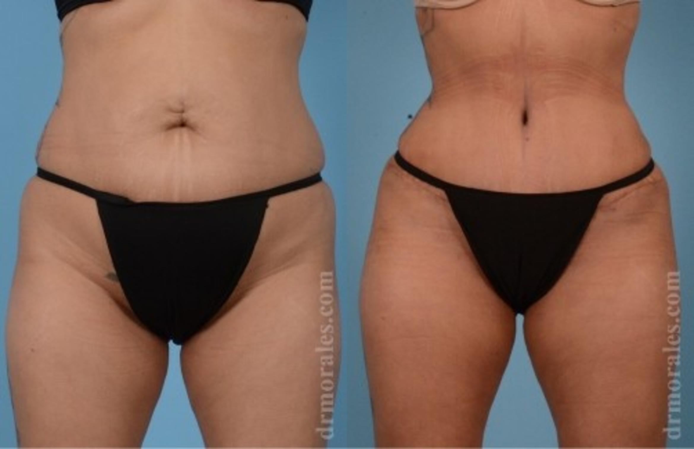 Before & After Tummy Tuck Case 557 View 1 View in Houston, TX