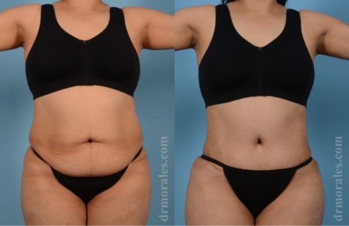 Before & After Tummy Tuck Case 558 View 1 View in Houston, TX