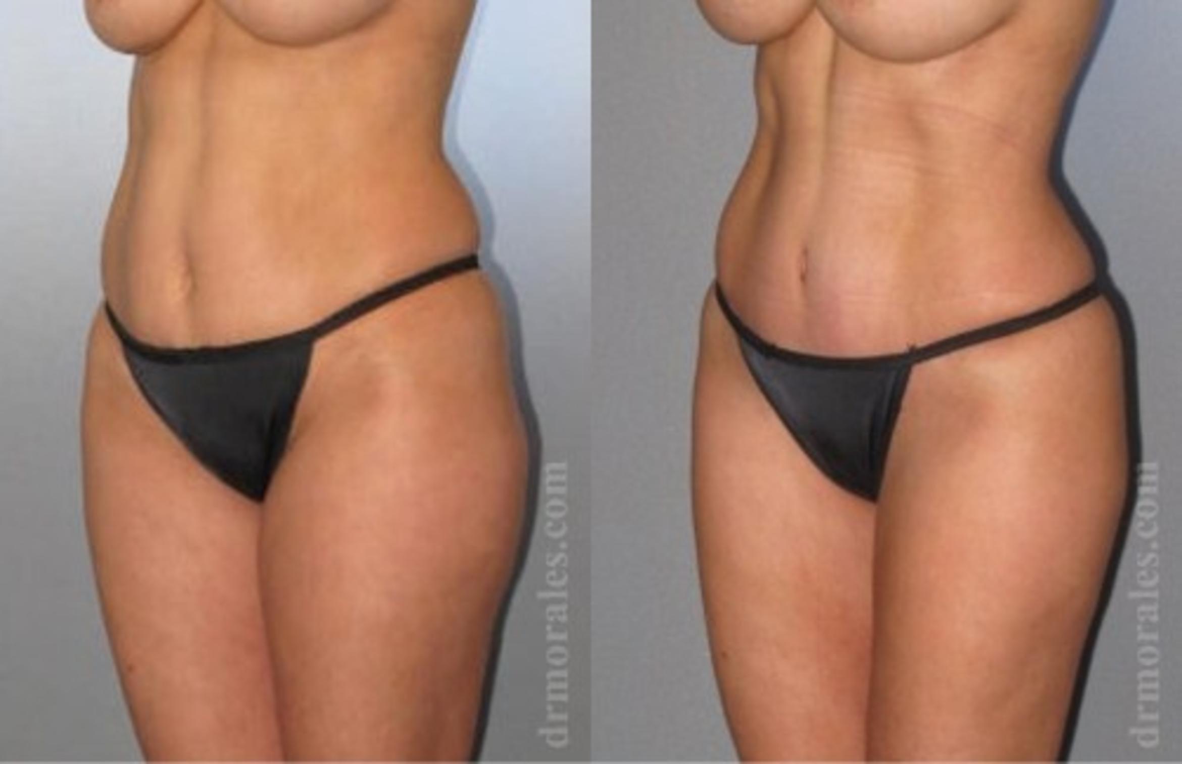 Before & After Tummy Tuck Case 560 View 1 View in Houston, TX