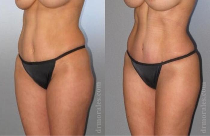 Before & After Tummy Tuck Case 560 View 1 View in Houston, TX