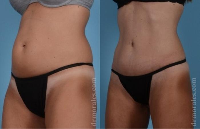Before & After Tummy Tuck Case 562 View 1 View in Houston, TX