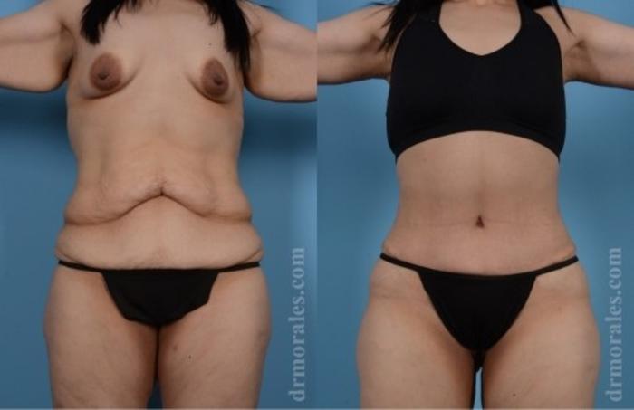 Before & After Tummy Tuck Case 563 View 1 View in Houston, TX