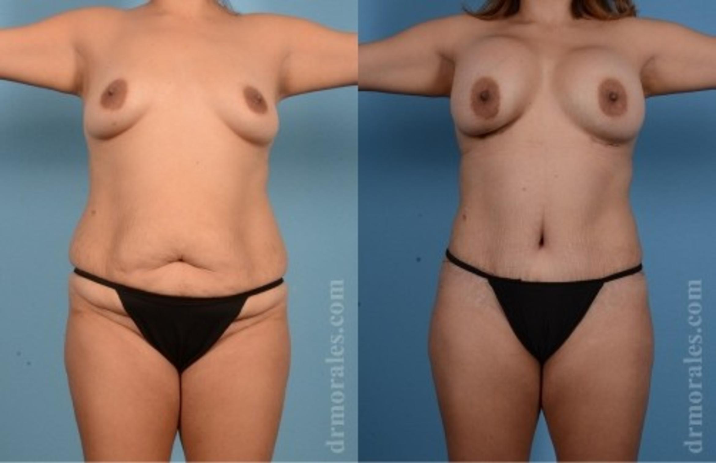 Before & After Tummy Tuck Case 564 View 1 View in Houston, TX