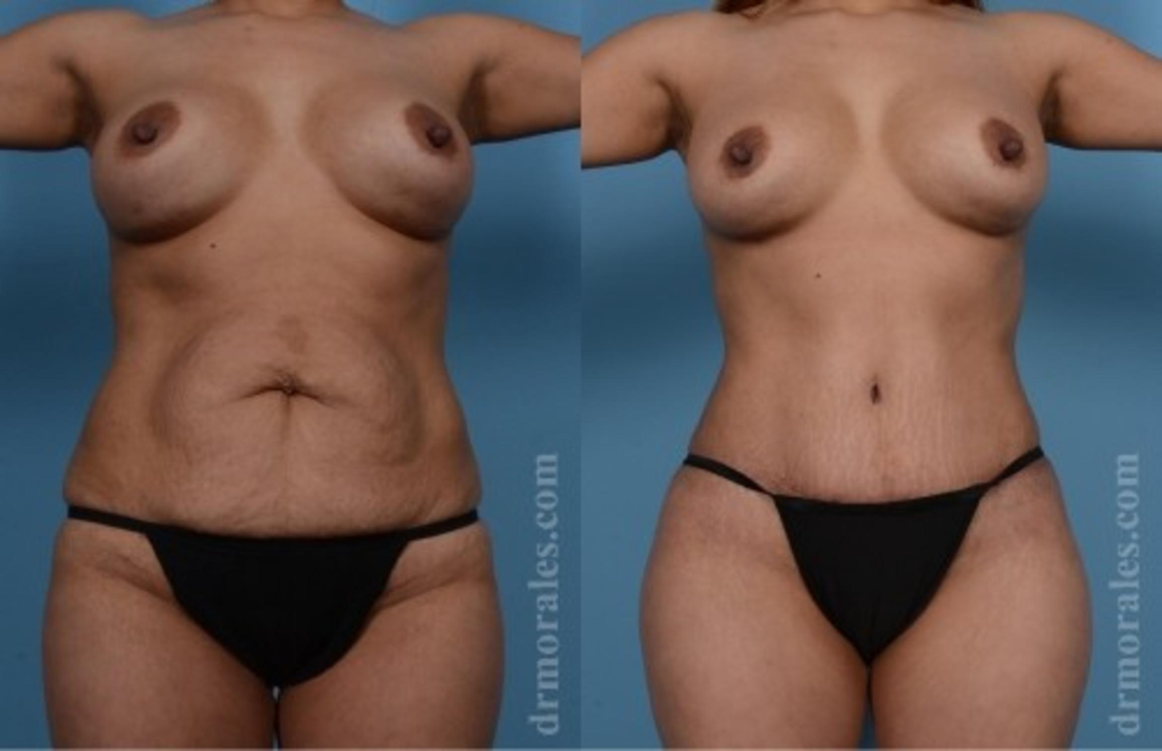 Before & After Tummy Tuck Case 565 View 1 View in Houston, TX