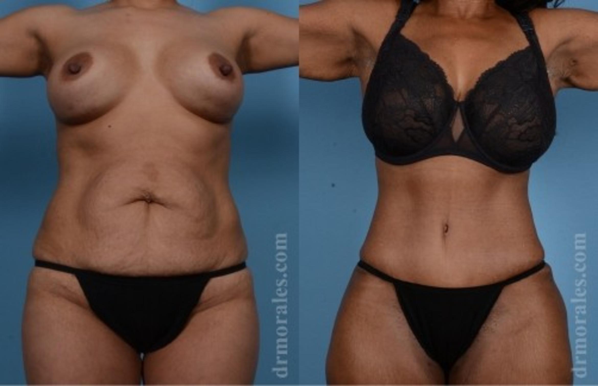Before & After Tummy Tuck Case 566 View 1 View in Houston, TX