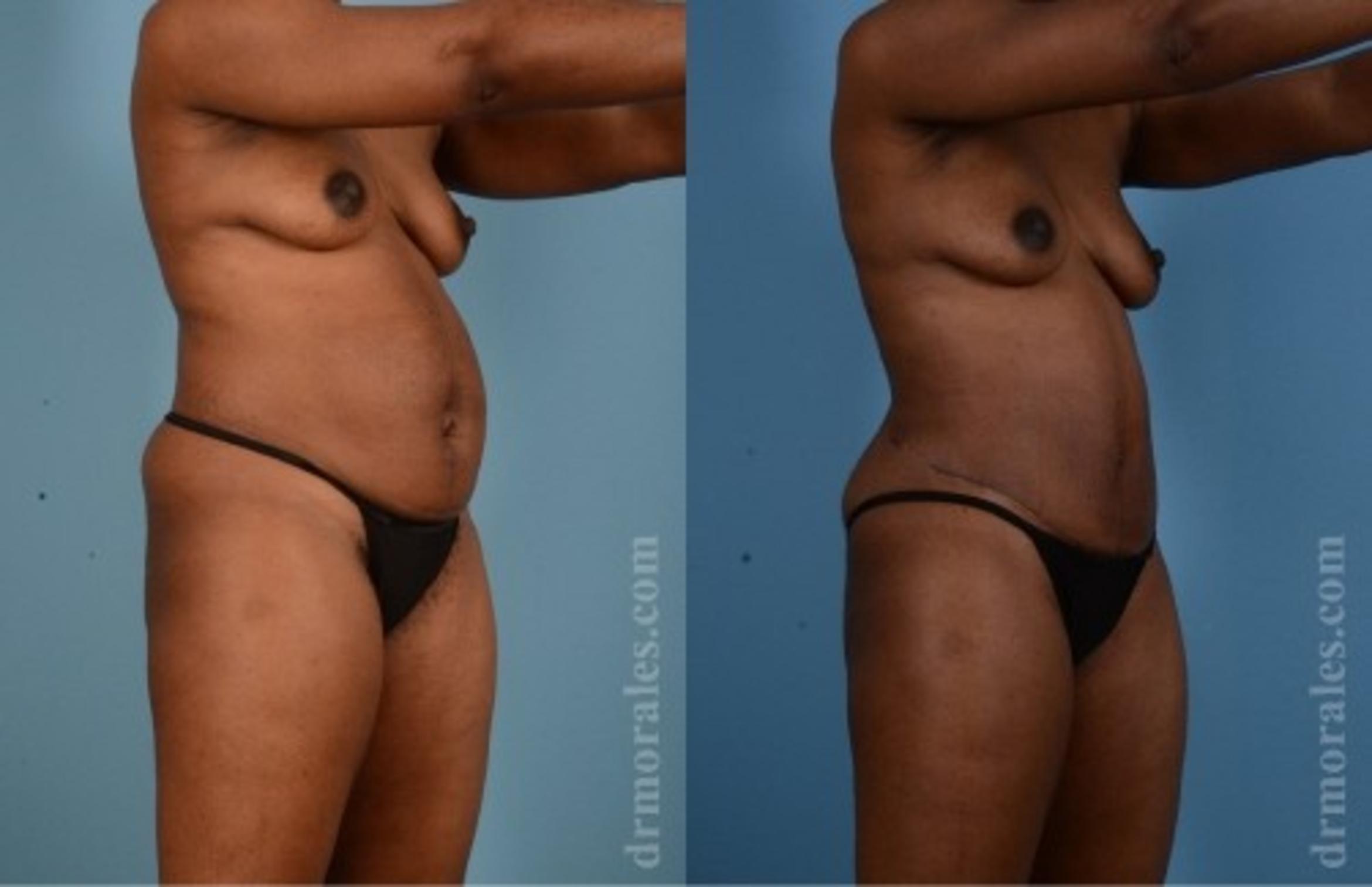 Before & After Tummy Tuck Case 567 View 1 View in Houston, TX