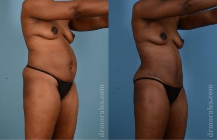 Before & After Tummy Tuck Case 567 View 1 View in Houston, TX