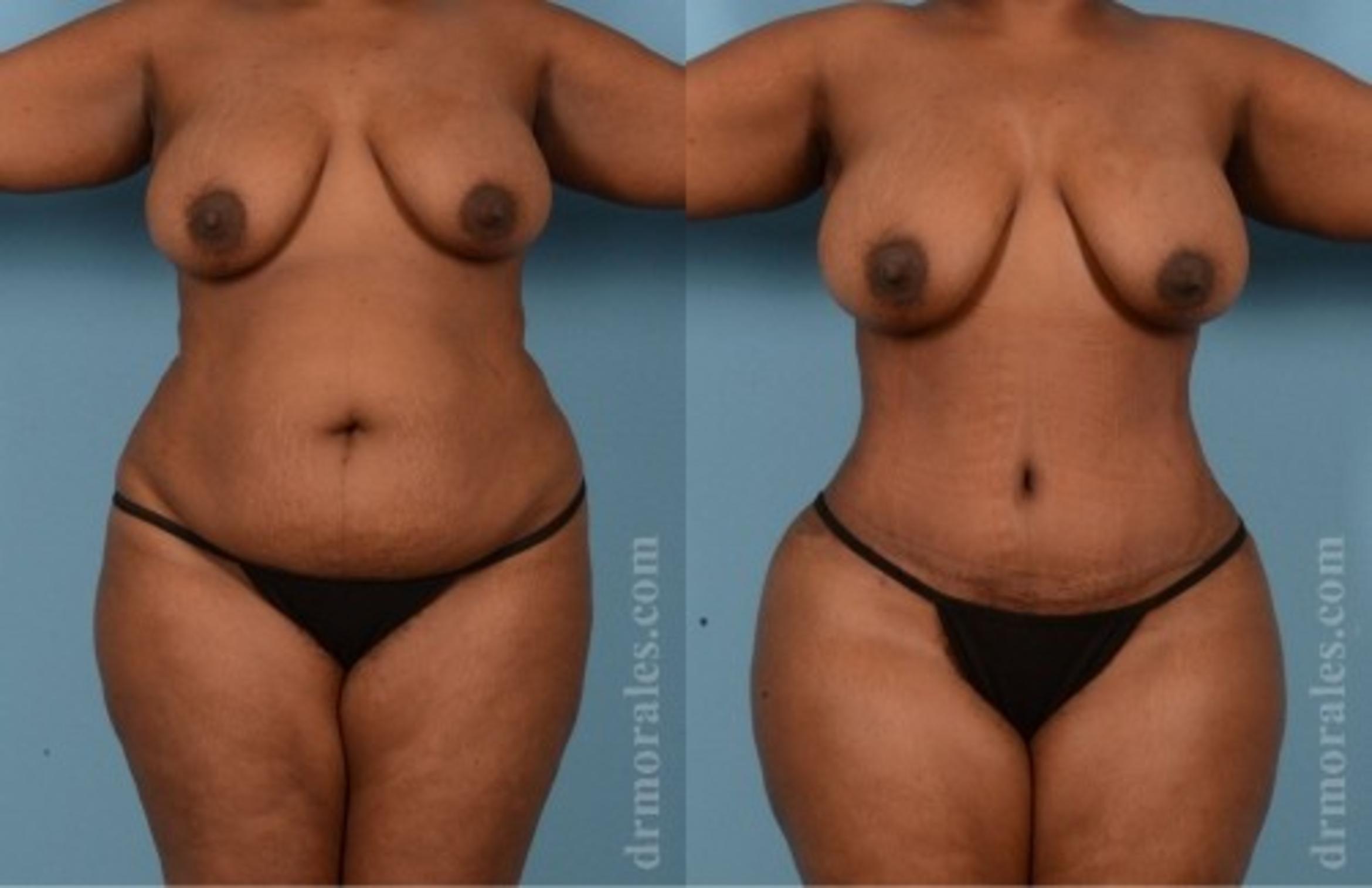 Before & After Tummy Tuck Case 568 View 1 View in Houston, TX