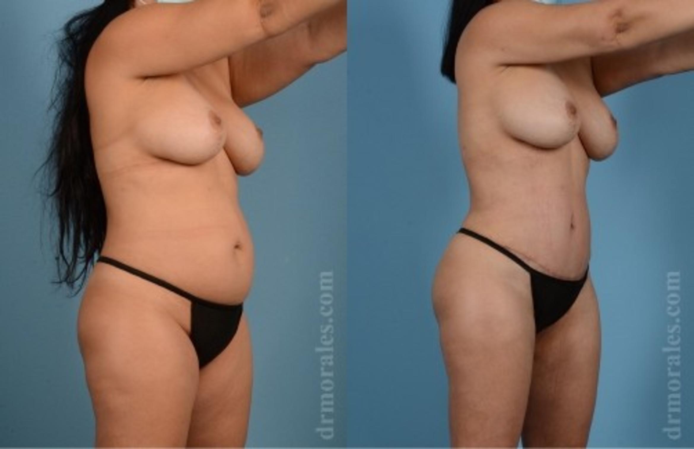 Before & After Tummy Tuck Case 569 View 1 View in Houston, TX
