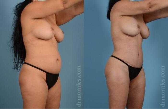 Before & After Tummy Tuck Case 569 View 1 View in Houston, TX