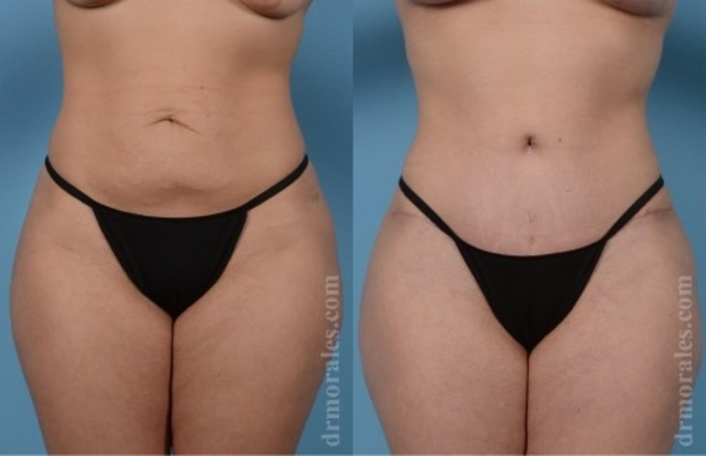 Before & After Tummy Tuck Case 570 View 1 View in Houston, TX