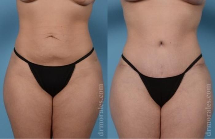 Before & After Tummy Tuck Case 570 View 1 View in Houston, TX